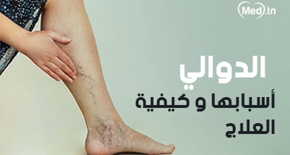 الدوالي أسبابها و كيفية العلاج