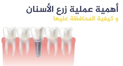 أهمية عملية زرع الأسنان و كيفية المحافظة عليها