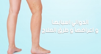الدوالي : اسبابها و اعراضها و طرق العلاج