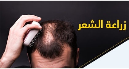 زراعة الشّعر