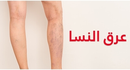 عرق النسا