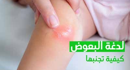 لدغة البعوض كيفية تجنبها
