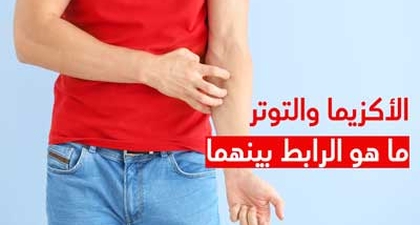 الأكزيما والتوتر ما هو الرابط بينهما
