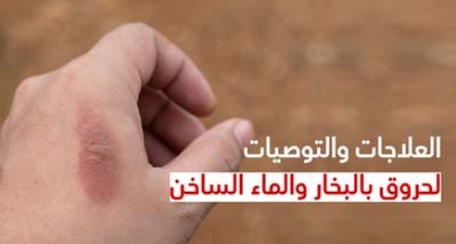 العلاجات والتوصيات لحروق بالبخار والماء الساخن