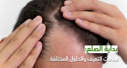 بداية الصلع: علامات التعرف والحلول المختلفة