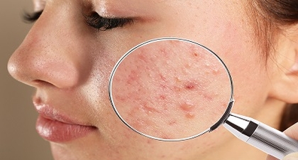 حبّ الشّباب : حامض الساليسيليك وأهمّيته في علاج العدّ