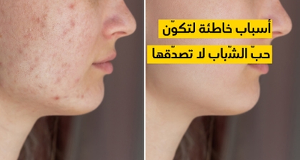 أسباب خاطئة لتكوّن حبّ الشّباب لا تصدّقها