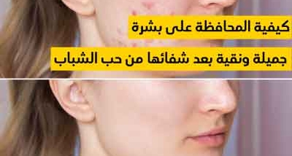 كيفية المحافظة على بشرة جميلة ونقية بعد شفائها من حب الشباب