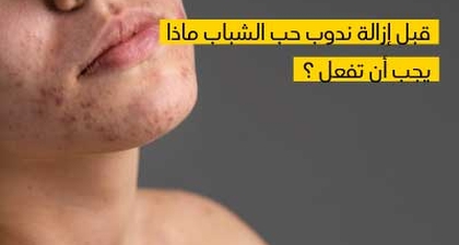 قبل إزالة ندوب حب الشباب ماذا يجب أن تفعل ؟
