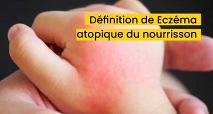 Définition de Eczéma atopique du nourrisson