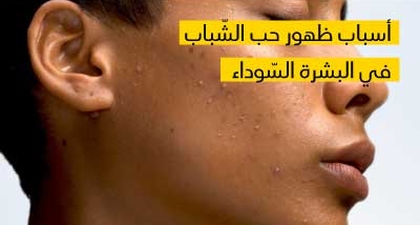   أسباب ظهور حب الشّباب في البشرة السّوداء
