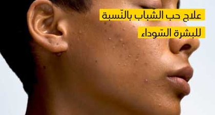  علاج حب الشّباب بالنّسبة للبشرة السّوداء 