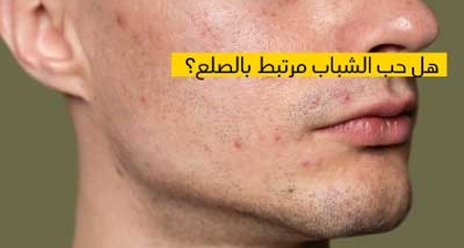 هل حب الشباب مرتبط بالصلع ؟