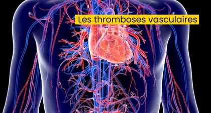 Les thromboses vasculaires