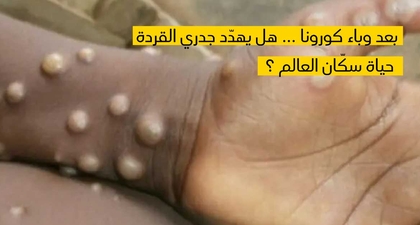 بعد وباء كورونا ... هل يهدّد جدري القردة حياة سكّان العالم ؟