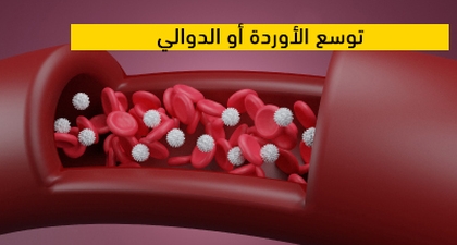  توسع الأوردة أو الدوالي  