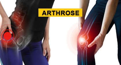 Arthrose