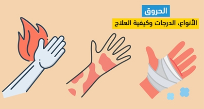 الحروق: الأنواع، الدرجات وكيفية العلاج
