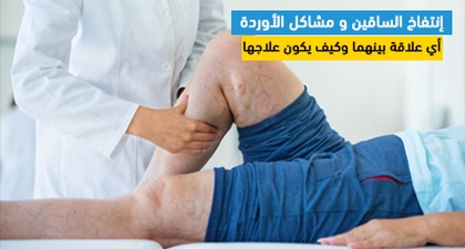 إنتفاخ الساقين و مشاكل الأوردة: أي علاقة بينهما وكيف يكون علاجها