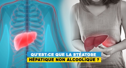 Qu'est-ce que la stéatose hépatique non alcoolique ?
