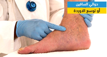 دوالي الساقين أو توسع الدوالي
