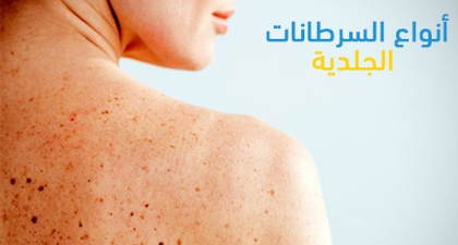 أنواع السرطانات الجلدية