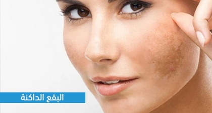 البقع الداكنة