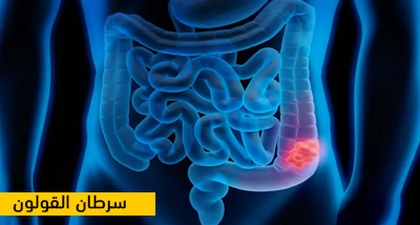 سرطان القولون
