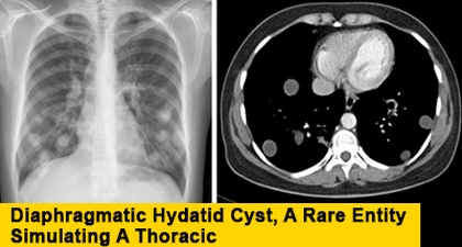 Diaphragmatic Hydatid Cyst, A Rare Entity Simulating A Thoracic
