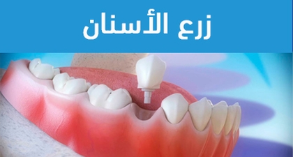 زرع الأسنان