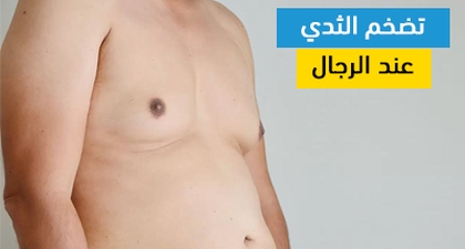 تضخم الثدي عند الرجال
