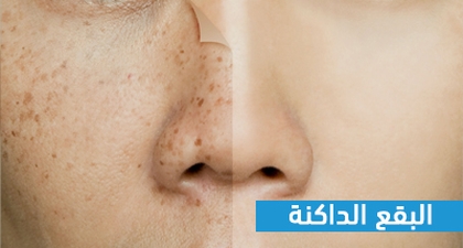 البقع الدكنة