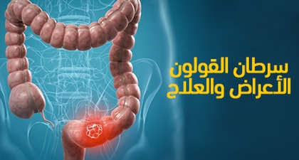 سرطان القولون : الأعراض والعلاج