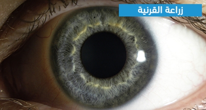 زراعة القرنية