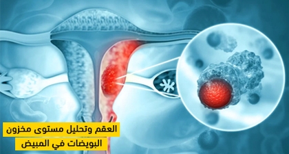 العقم وتحليل مستوى مخزون البويضات في المبيض