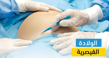 الولادة القيصرية