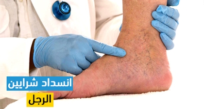 انسداد شرايين الرجل
