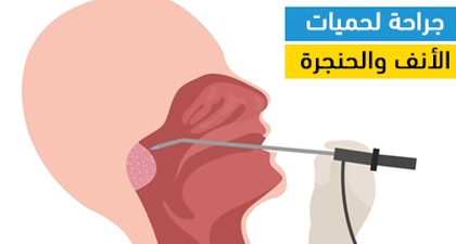 جراحة لحمات الأنف والحنجرة