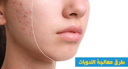 طرق معالجة الندوبات
