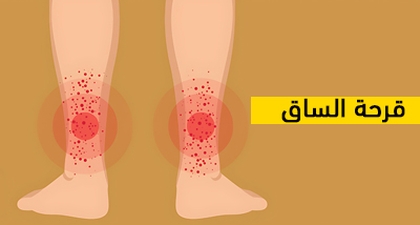 قرحة الساق