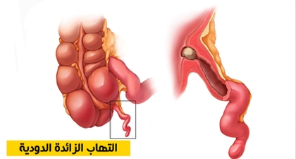 التهاب الزائدة الدودية