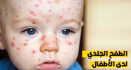 الطفح الجلدي لدى الأطفال