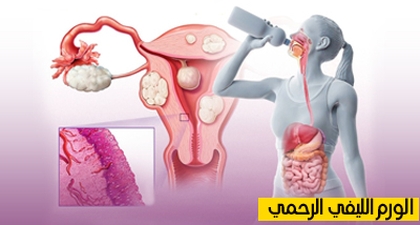 الورم الليفي الرحمي
