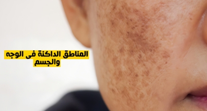 المناطق الداكنة في الوجه والجسم