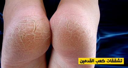 تشققات كعب القدمين