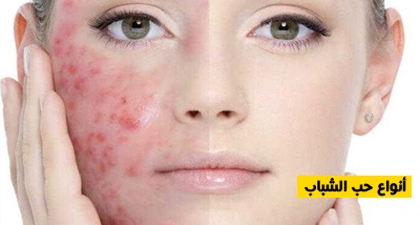 أنواع حب الشباب