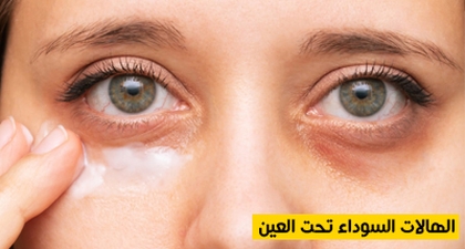 الهالات السوداء تحت العين