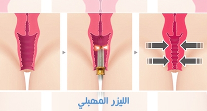 الليزر المهبلي
