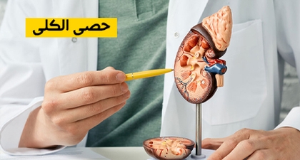 حصى الكلى