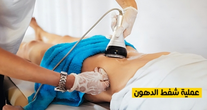عملية شفط الدهون
